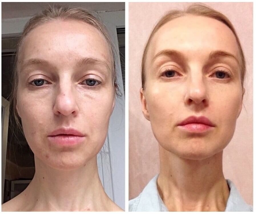 Лпджи массаж лица фото до и после